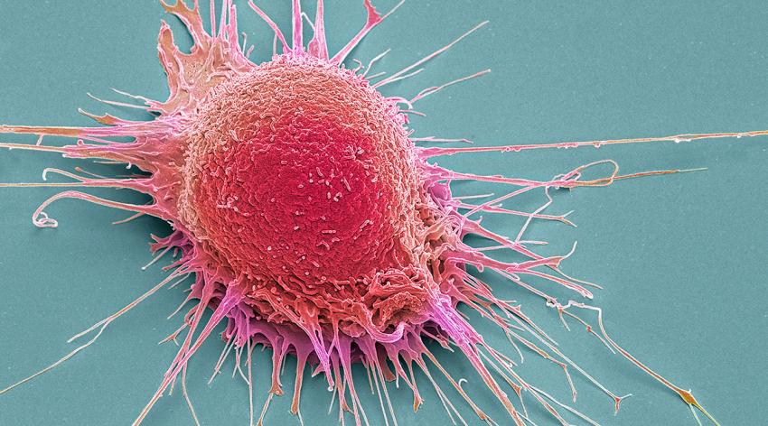 Prostate cancer cell, coloured scanning electron micrograph (SEM)